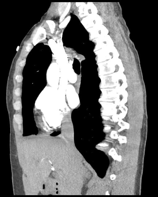 Aortic valve non-coronary cusp thrombus (Radiopaedia 55661-62189 D 31).png