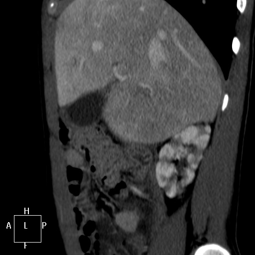 Aorto-left renal vein fistula (Radiopaedia 45534-49628 C 3).jpg