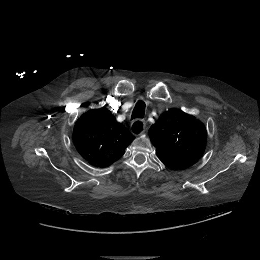 Aortoesophageal fistula with endovascular repair (Radiopaedia 73781-84592 Axial C+ CTPA 12).jpg