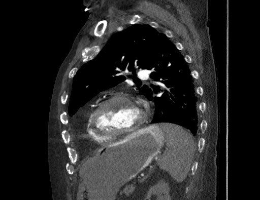 Aortoesophageal fistula with endovascular repair (Radiopaedia 73781-84592 Sagittal C+ CTPA 136).jpg