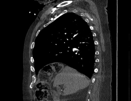 Aortoesophageal fistula with endovascular repair (Radiopaedia 73781-84592 Sagittal C+ CTPA 62).jpg
