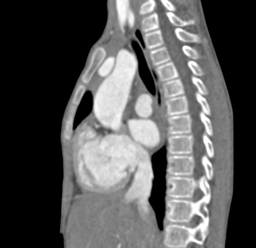 File:Aortopulmonary window, interrupted aortic arch and large PDA giving the descending aorta (Radiopaedia 35573-37074 C 11).jpg