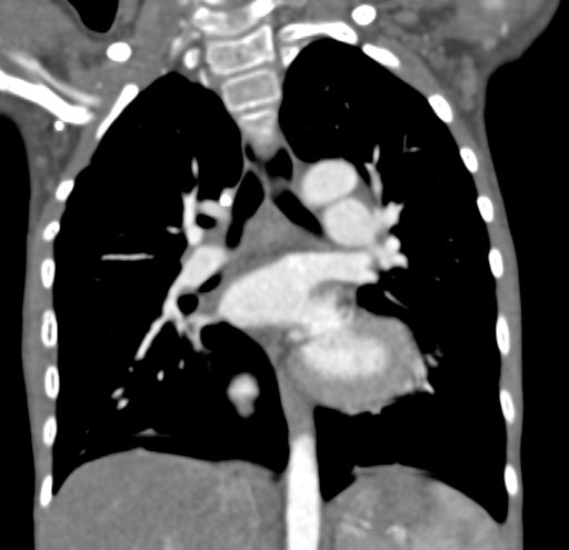 File:Aortopulmonary window, interrupted aortic arch and large PDA giving the descending aorta (Radiopaedia 35573-37074 D 40).jpg