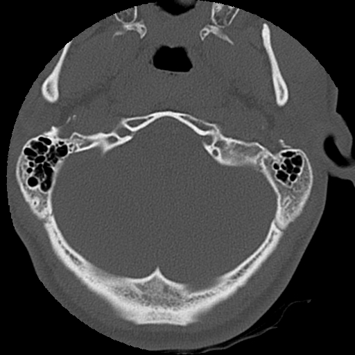 File:Apical pneumothorax on cervical spine CT (Radiopaedia 45343-49368 Axial bone window 3).jpg