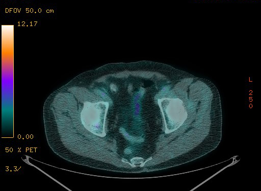 Appendiceal adenocarcinoma complicated by retroperitoneal abscess (Radiopaedia 58007-65041 Axial PET-CT 179).jpg