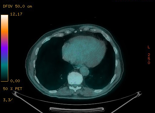 Appendiceal adenocarcinoma complicated by retroperitoneal abscess (Radiopaedia 58007-65041 Axial PET-CT 89).jpg