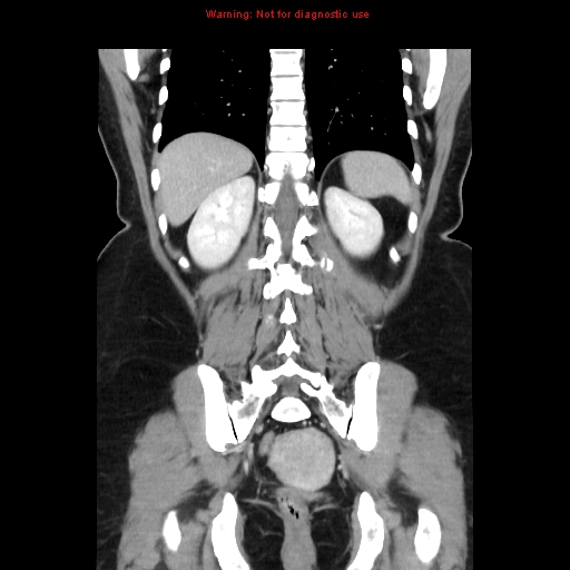 Appendiceal mucinous cystadenoma (Radiopaedia 8263-9111 B 56).jpg