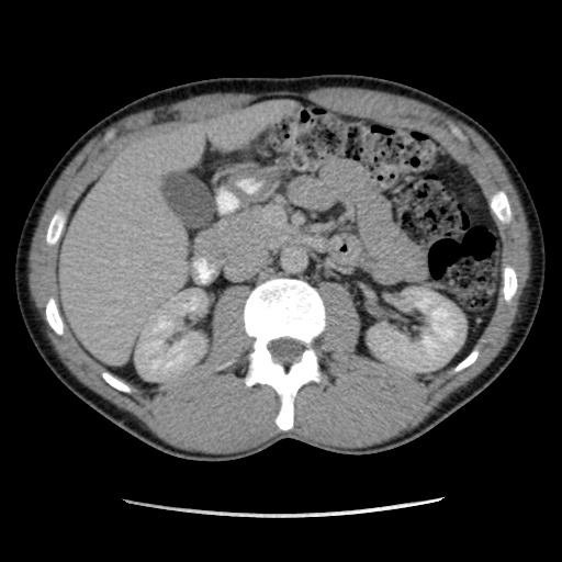 File:Appendicitis complicated by post-operative collection (Radiopaedia 35595-37113 A 26).jpg