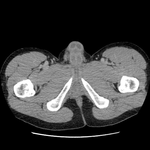 File:Appendicitis complicated by post-operative collection (Radiopaedia 35595-37113 A 87).jpg
