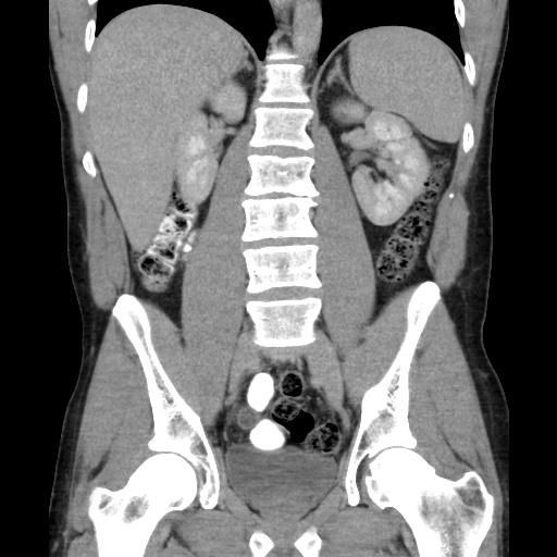 File:Appendicitis complicated by post-operative collection (Radiopaedia 35595-37113 B 33).jpg