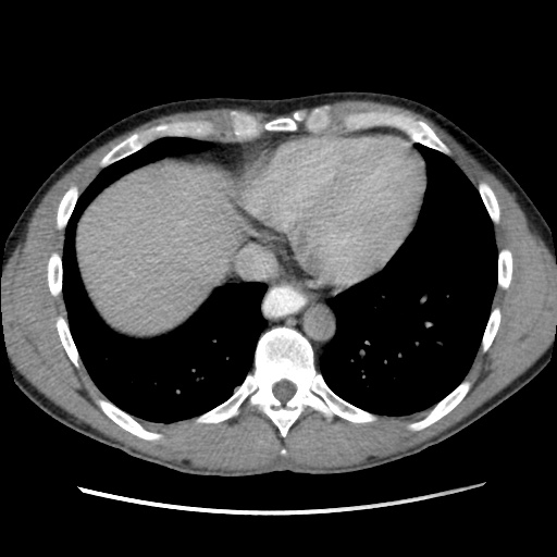 File:Appendicitis complicated by post-operative collection (Radiopaedia 35595-37114 A 9).jpg