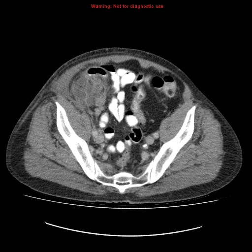 File:Appendicitis mass in inguinal hernia (Radiopaedia 26858-27029 A 15).jpg