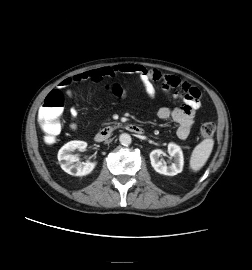 Appendicitis with localized perforation and abscess formation (Radiopaedia 49035-54130 A 40).jpg