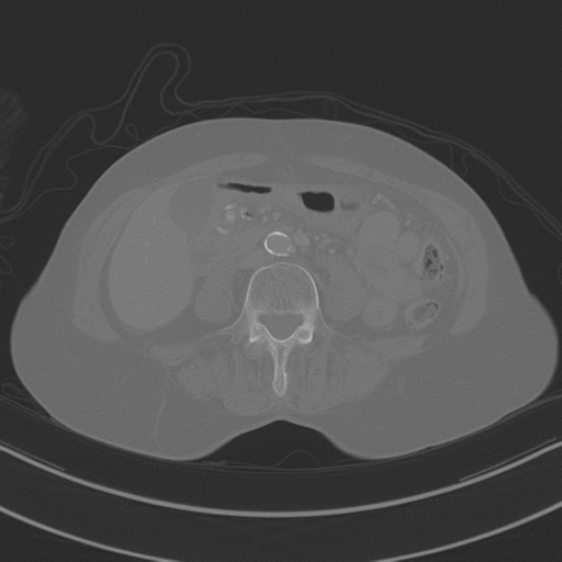 April fools' 2019- calcified peritoneal arachnoidosis (Radiopaedia 67273-76636 Axial bone window 23).png