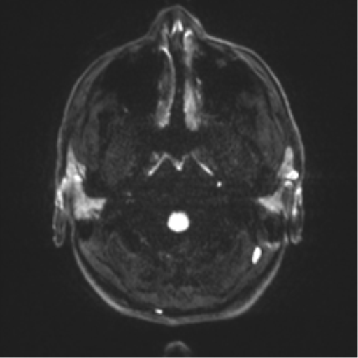 Arachnoid cyst - cerebellopontine angle (Radiopaedia 59689-67083 Axial DWI 38).png