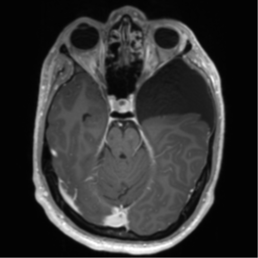 Arachnoid cyst with subdural hematoma (Radiopaedia 85892-101743 Axial T1 C+ 33).png