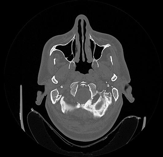 Arcuate foramen (Radiopaedia 89833-106944 Axial bone window 4).jpg