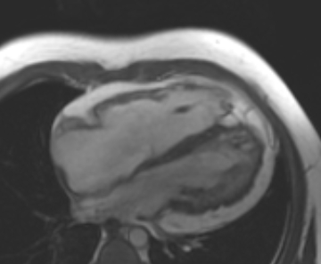 Arrhythmogenic right ventricular cardiomyopathy (Radiopaedia 69431-79307 4ch cine 54).jpg