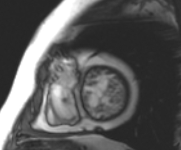 Arrhythmogenic right ventricular cardiomyopathy (Radiopaedia 69431-79307 Short axis cine 60).jpg