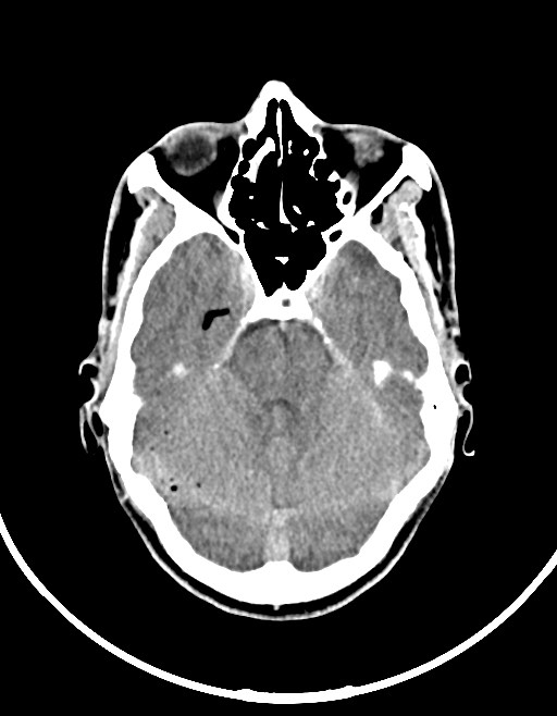 Arrow injury to the brain (Radiopaedia 72101-82607 Axial non-contrast 61).jpg