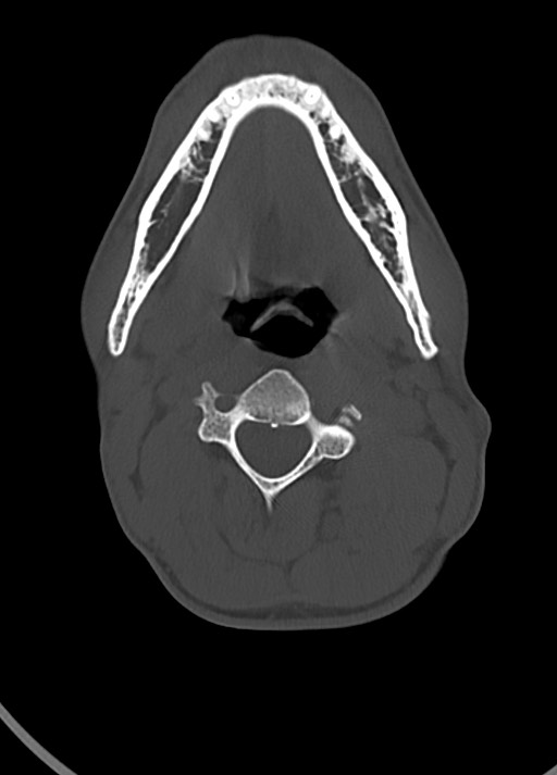 Arrow injury to the head (Radiopaedia 75266-86388 Axial bone window 19).jpg