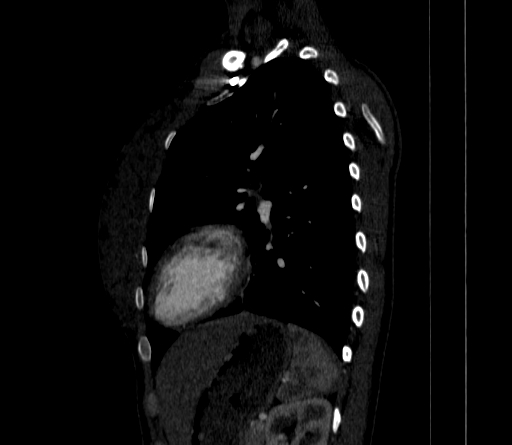 Arteria lusoria (Radiopaedia 88528-105192 C 66).jpg