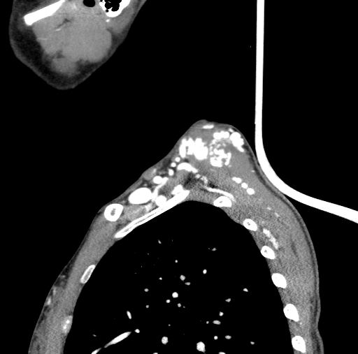 Arteriovenous malformation of the neck (Radiopaedia 53935-60062 C 8).jpg