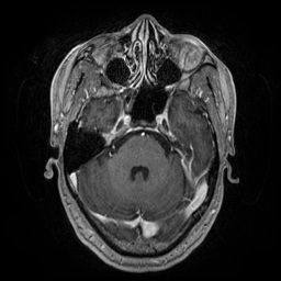 Artery of Percheron infarction (Radiopaedia 27975-28230 Axial T1 C+ fat sat 28).jpg