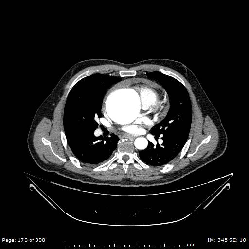 Ascending aortic aneurysm (Radiopaedia 50086-55404 A 45).jpg
