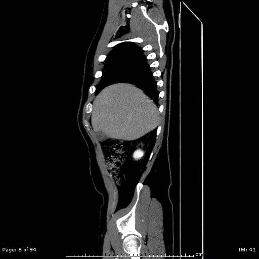 File:Ascending aortic aneurysm (Radiopaedia 50086-55404 C 6).jpg