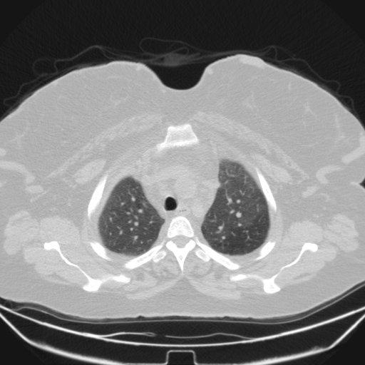 Aspergilloma (Radiopaedia 39611-41932 Axial lung window 22).jpg