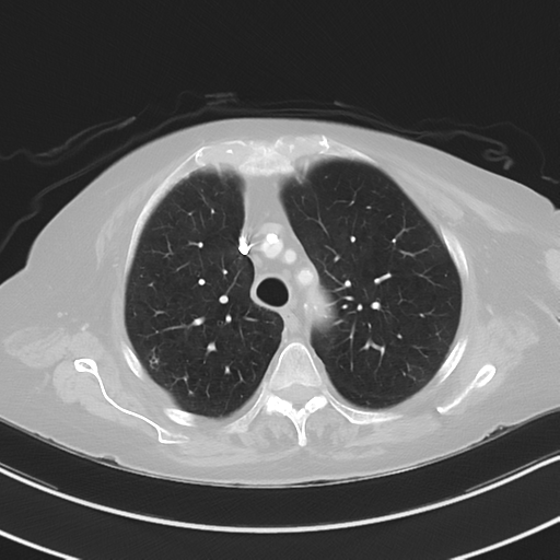 Aspiration bronchiolitis (Radiopaedia 53464-59463 Axial lung window 15).png