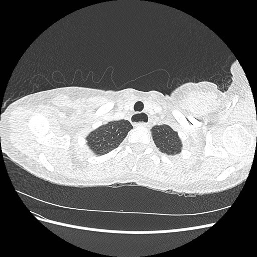 Aspiration pneumonia secondary to laparoscopic banding (Radiopaedia 18345-18183 lung window 5).jpg