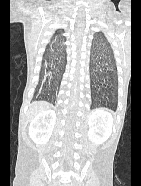 Asplenia syndrome (Radiopaedia 73083-83792 Coronal lung window 114).jpg