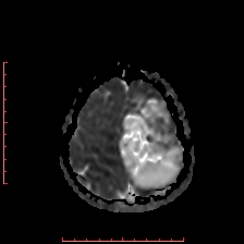 File:Astroblastoma (Radiopaedia 74287-85162 Axial ADC 59).jpg