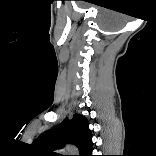 Atlanto-occipital dissociation (Traynelis type 1), C2 teardrop fracture, C6-7 facet joint dislocation (Radiopaedia 87655-104061 D 59).jpg