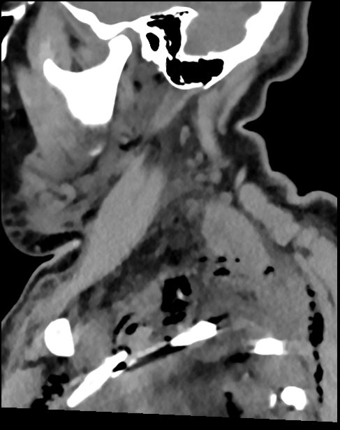 Atlanto-occipital dissociation - Traynelis type 1 (Radiopaedia 87570-103948 D 21).jpg