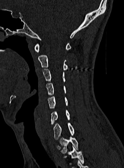 Atlantoaxial subluxation (Radiopaedia 44681-48450 Sagittal bone window 49).jpg