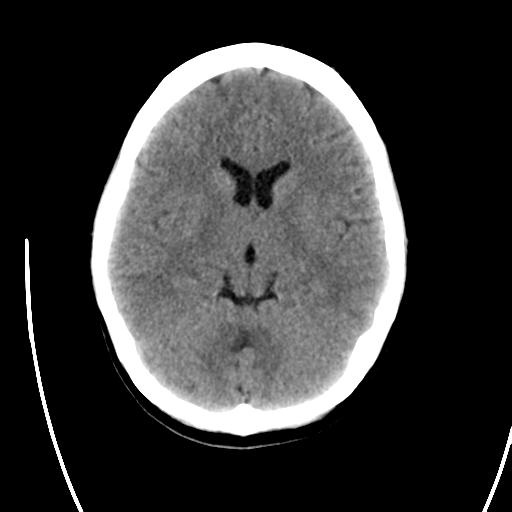 File:Atretic encephalocoele with inferior vermis hypoplasia (Radiopaedia 30443-31107 A 12).jpg