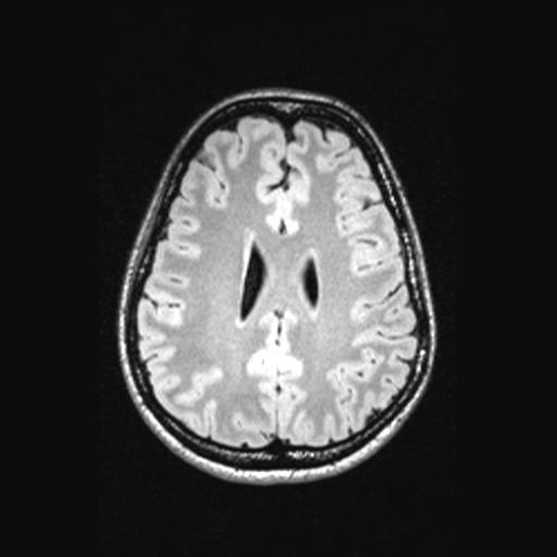 Atretic encephalocoele with inferior vermis hypoplasia (Radiopaedia 30443-31108 Axial 106).jpg