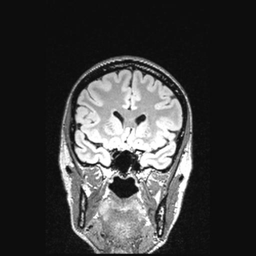 Atretic encephalocoele with inferior vermis hypoplasia (Radiopaedia 30443-31108 Coronal FLAIR 124).jpg