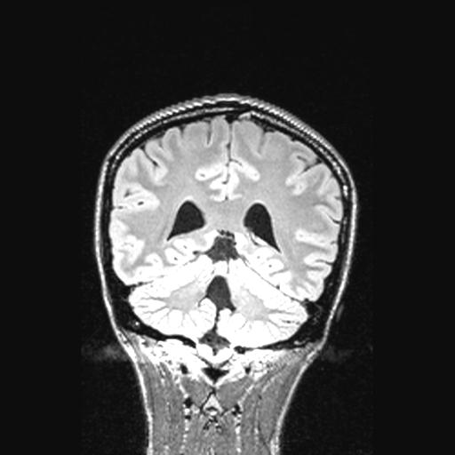 File:Atretic encephalocoele with inferior vermis hypoplasia (Radiopaedia 30443-31108 Coronal FLAIR 66).jpg