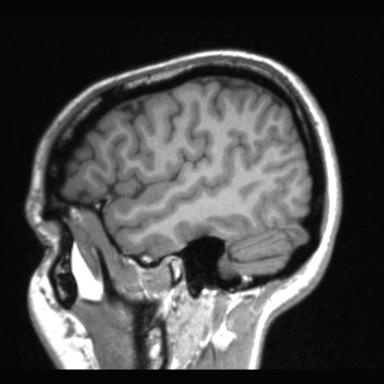 Atretic encephalocoele with inferior vermis hypoplasia (Radiopaedia 30443-31108 Sagittal T1 110).jpg