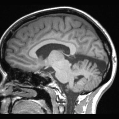 Atretic encephalocoele with inferior vermis hypoplasia (Radiopaedia 30443-31108 Sagittal T1 60).jpg