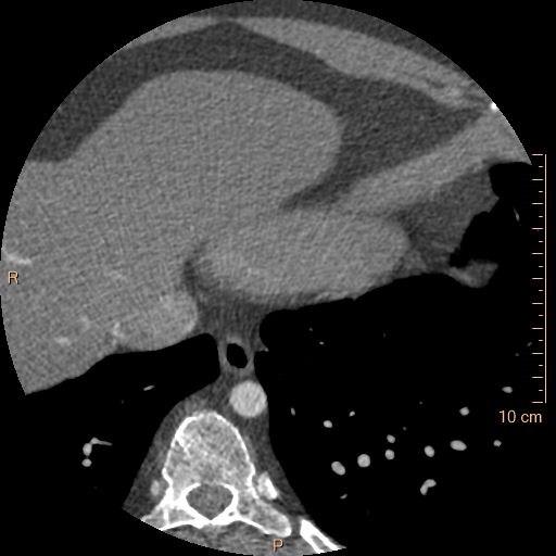 Atrial septal defect (upper sinus venosus type) with partial anomalous pulmonary venous return into superior vena cava (Radiopaedia 73228-83961 A 248).jpg