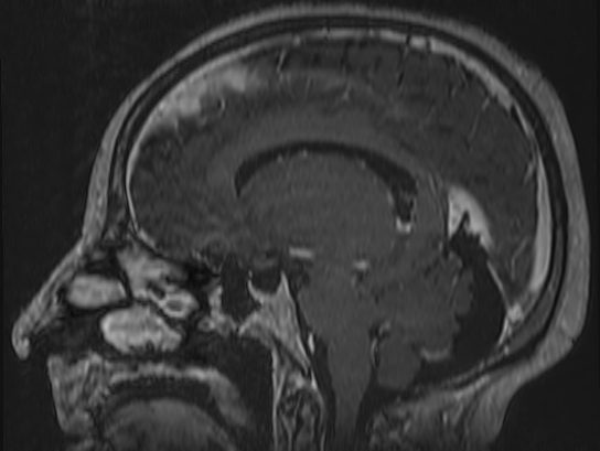 Atypical meningioma (Radiopaedia 62985-71406 Sagittal T1 C+ 48).jpg
