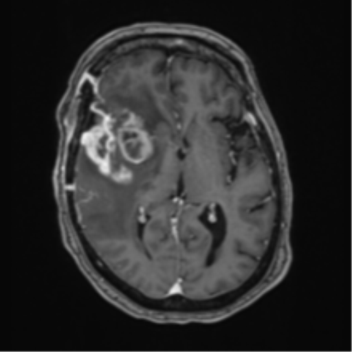 Atypical meningioma (WHO Grade II) (Radiopaedia 54742-60981 Axial T1 C+ 35).png