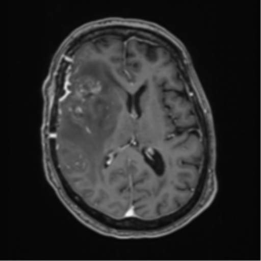 Atypical meningioma (WHO Grade II) (Radiopaedia 54742-60981 Axial T1 C+ 38).png