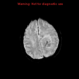 File:Atypical meningioma - grade II (Radiopaedia 13303-13305 Axial DWI 15).jpg
