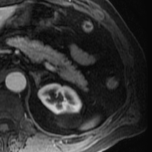 File:Atypical renal cyst on MRI (Radiopaedia 17349-17046 C 7).jpg